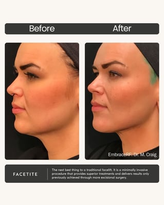 Before & After