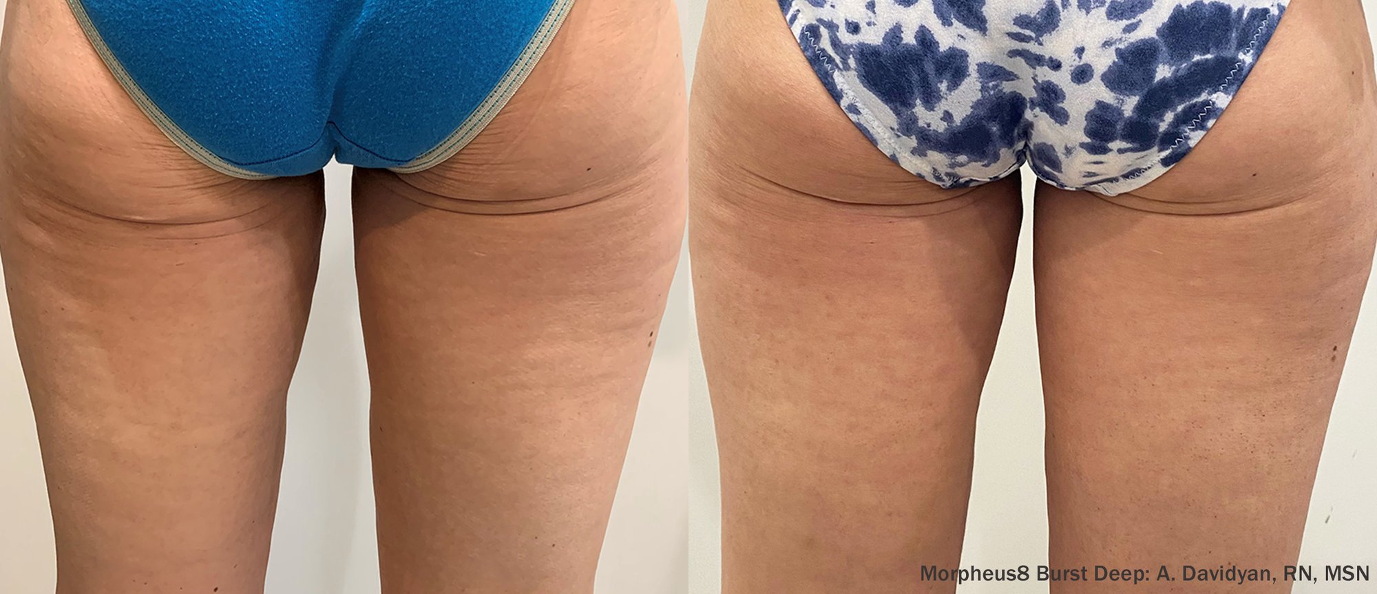 LA Beauty Skin Center_M8BD_Buttocks_Thighs_3Months-TM