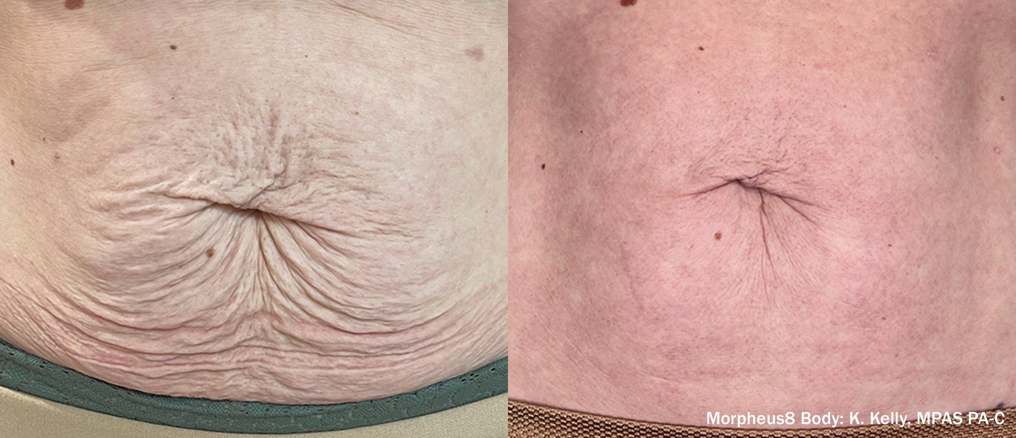 NB_M8B_Before&After_24Weeks_Abd_Zoomed-TM