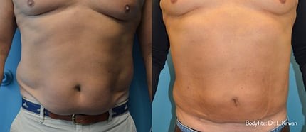 bodytite-before-after-dr-l-kirwan-preview-1-800-w