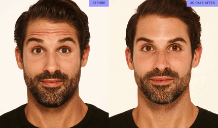 botox-before-and-after-male