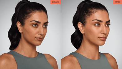 juvaderm-before-and-after-1