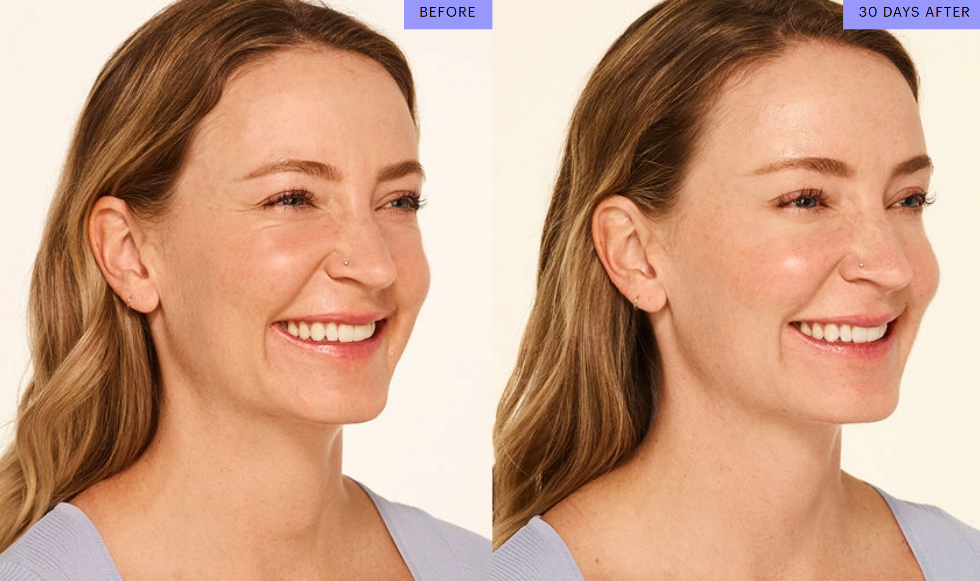 botox-before-and-after